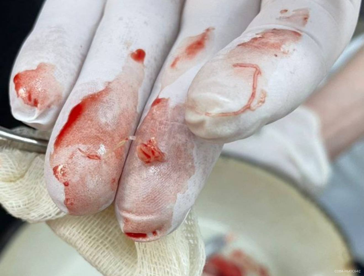Ленточного червя извлекли из ноги пациента доктора 6-й горбольницы Саратова